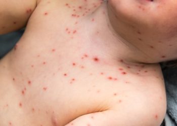 Vacinação de bebês em MS é antecipada após surto de sarampo na Bolívia