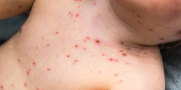 Vacinação de bebês em MS é antecipada após surto de sarampo na Bolívia